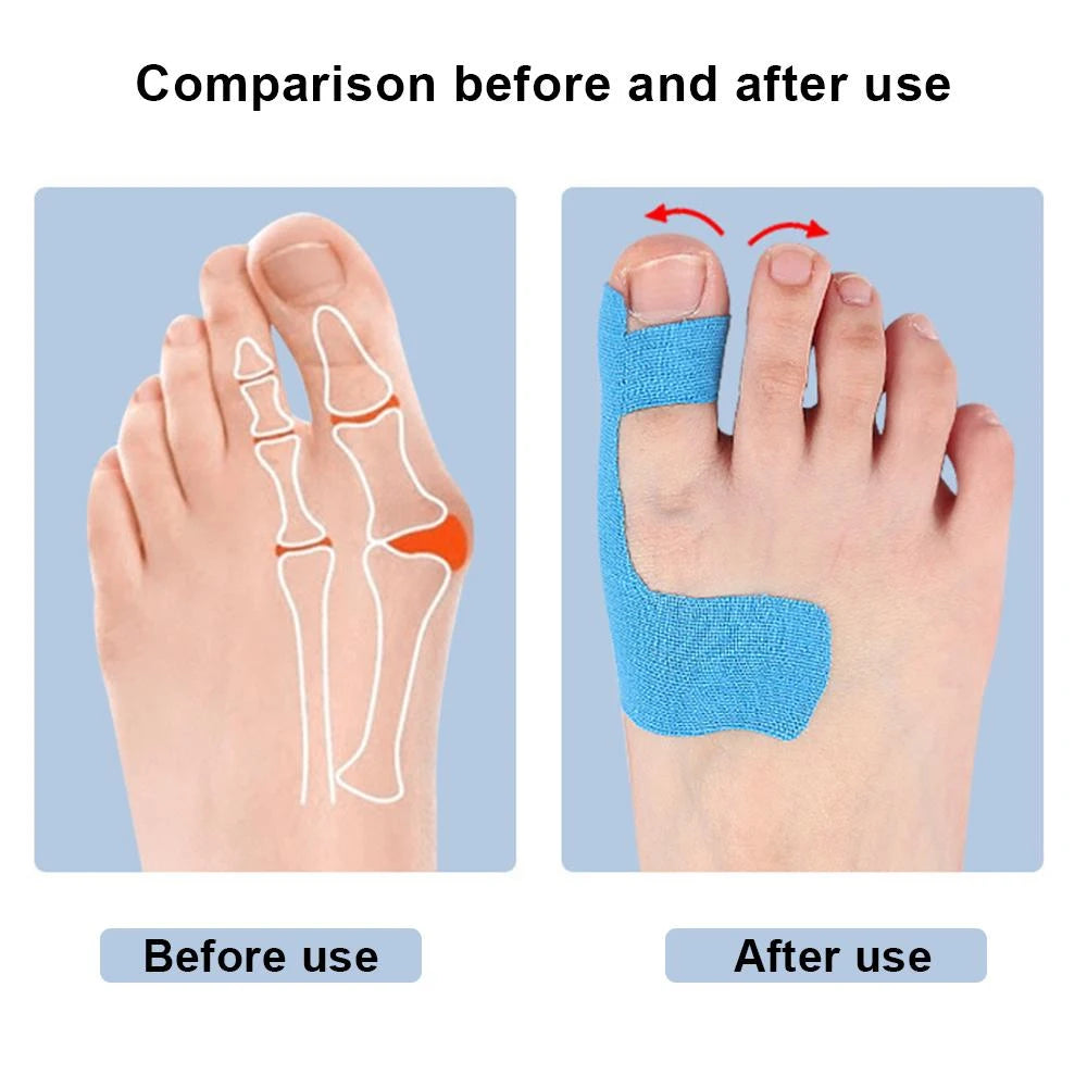Pre-Cut Kinesiology Toe Tape | Bunion Support & Toe Alignment Tape (10 PCS)